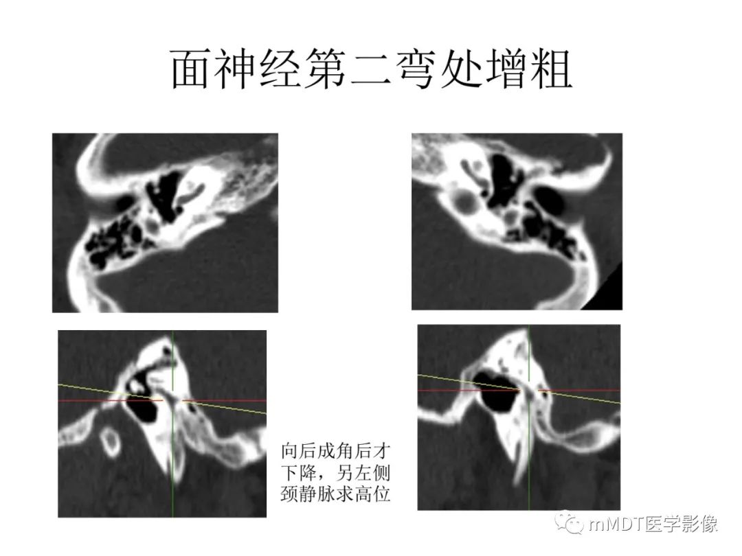 影像PPT - 【PPT】行走在孔道里的面神经-59