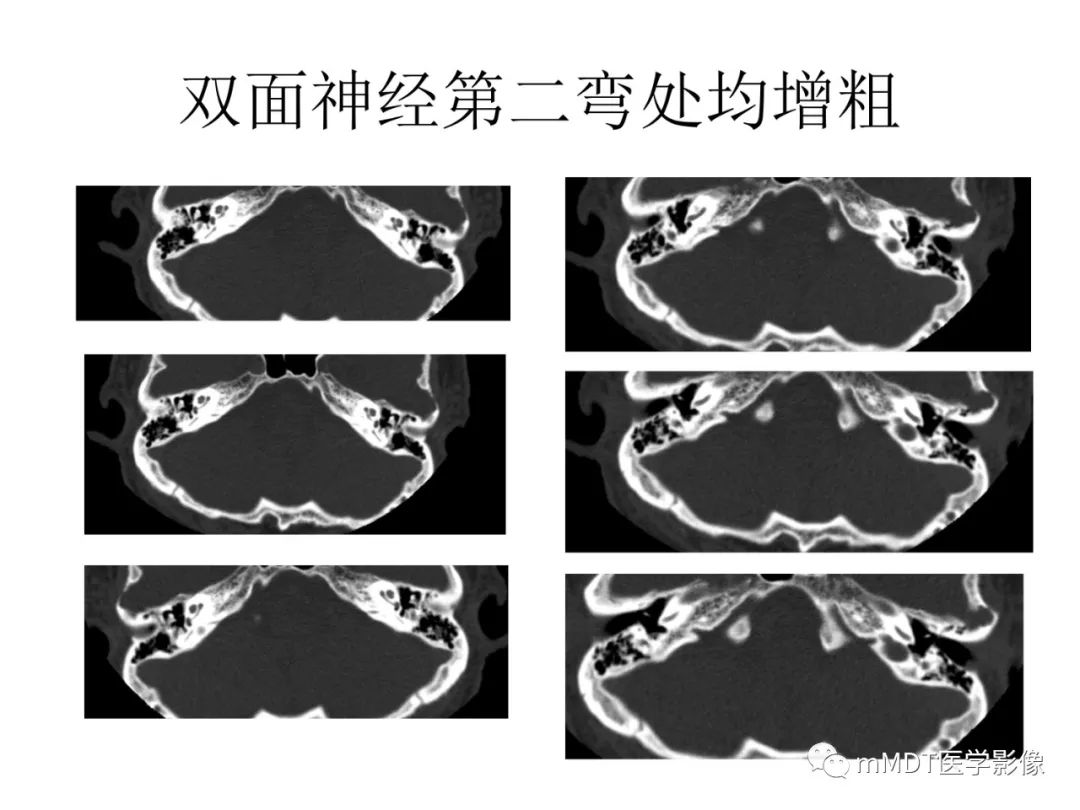 影像PPT - 【PPT】行走在孔道里的面神经-58