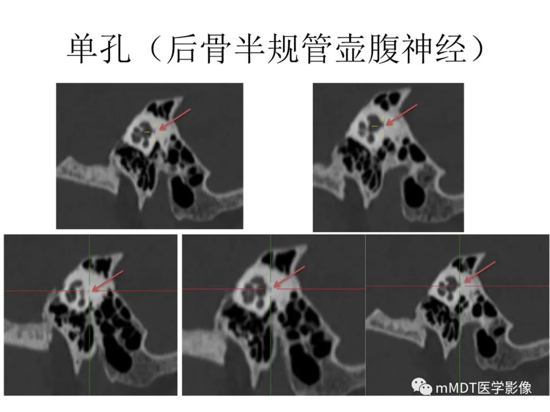 影像PPT - 【PPT】行走在孔道里的面神经-63