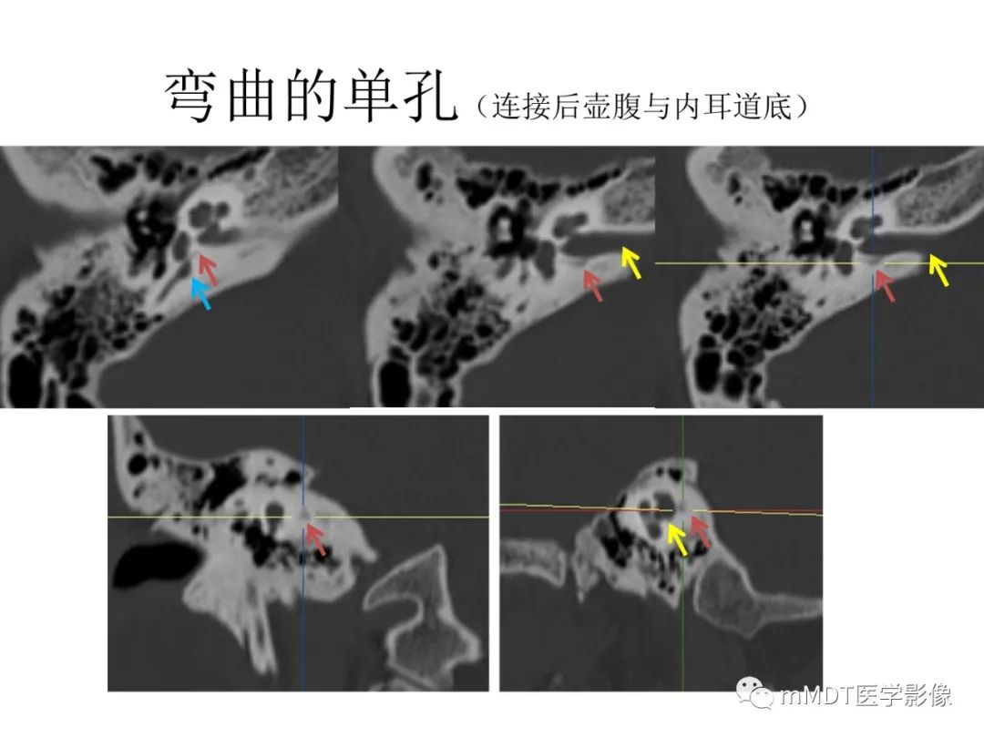 影像PPT - 【PPT】行走在孔道里的面神经-64