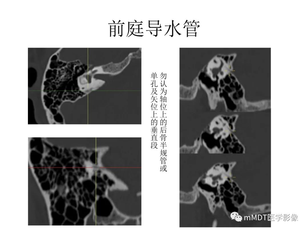 影像PPT - 【PPT】行走在孔道里的面神经-66