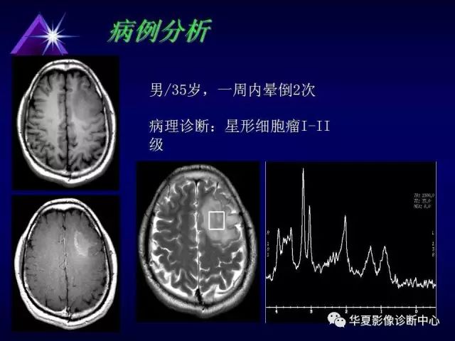 影像PPT - 【PPT】中枢神经系统MRS-18
