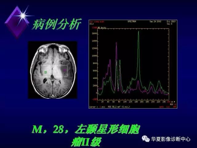 影像PPT - 【PPT】中枢神经系统MRS-19