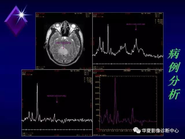影像PPT - 【PPT】中枢神经系统MRS-24