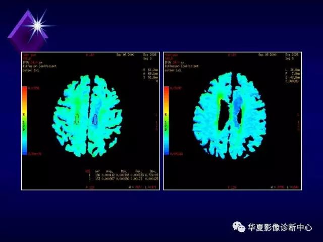 影像PPT - 【PPT】中枢神经系统MRS-28