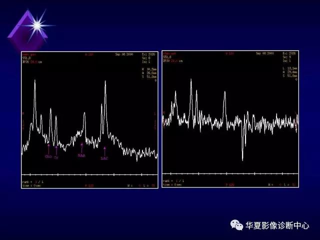 影像PPT - 【PPT】中枢神经系统MRS-29