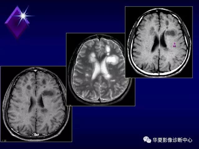 影像PPT - 【PPT】中枢神经系统MRS-33