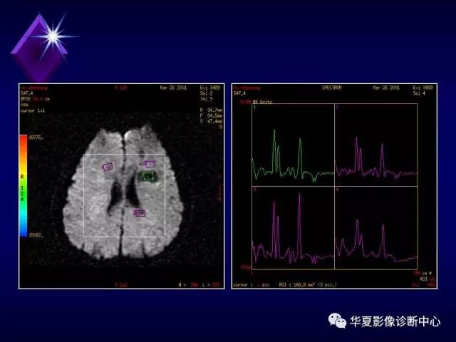 影像PPT - 【PPT】中枢神经系统MRS-34