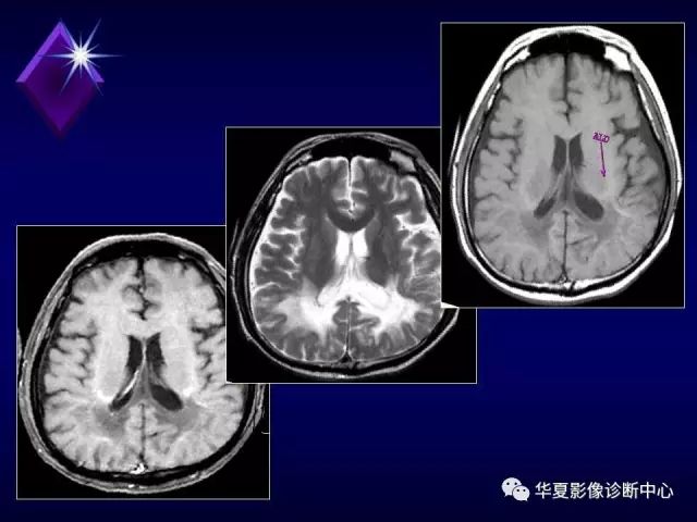 影像PPT - 【PPT】中枢神经系统MRS-35