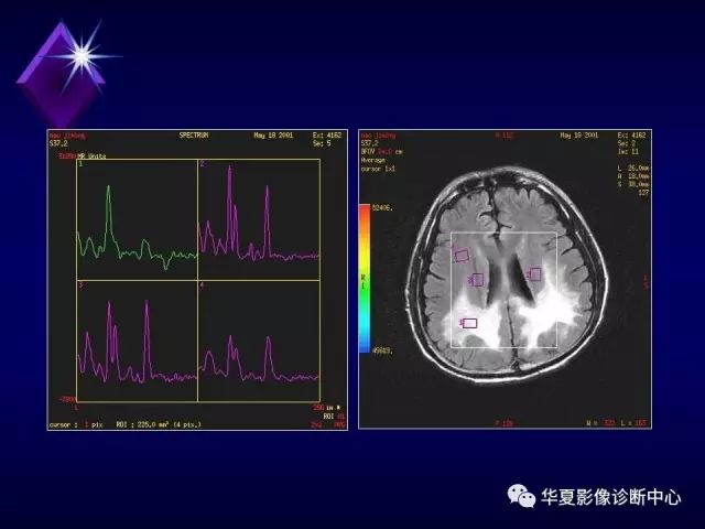 影像PPT - 【PPT】中枢神经系统MRS-37