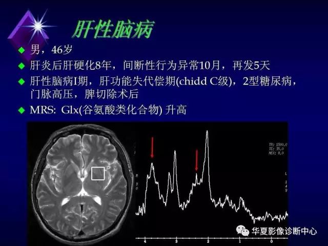 影像PPT - 【PPT】中枢神经系统MRS-38