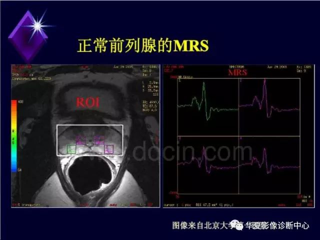 影像PPT - 【PPT】中枢神经系统MRS-43