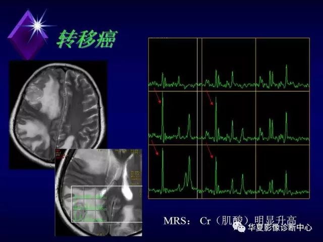 影像PPT - 【PPT】中枢神经系统MRS-39