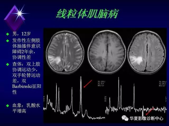 影像PPT - 【PPT】中枢神经系统MRS-40