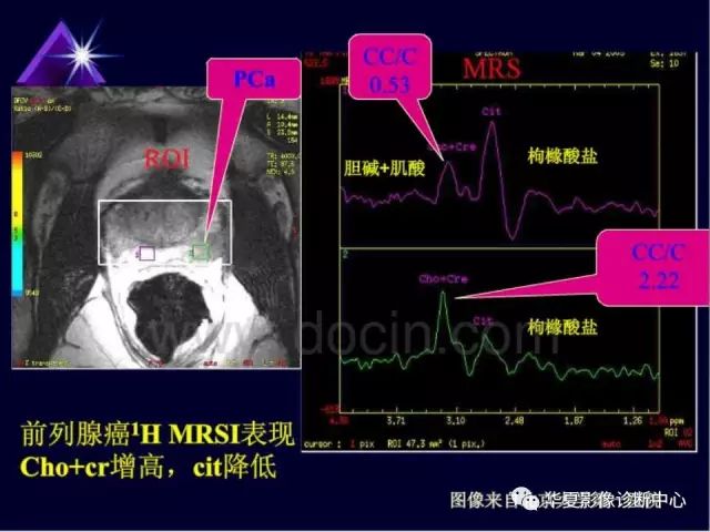 影像PPT - 【PPT】中枢神经系统MRS-45