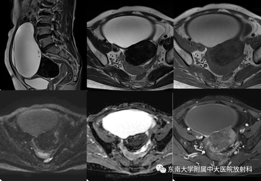 影像PPT - 【PPT】卵巢含纤维成份占位性病变分析-1