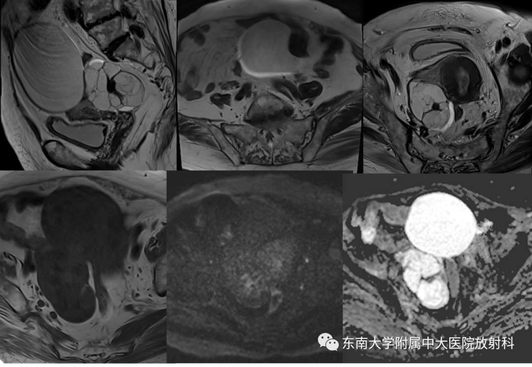 影像PPT - 【PPT】卵巢含纤维成份占位性病变分析-3