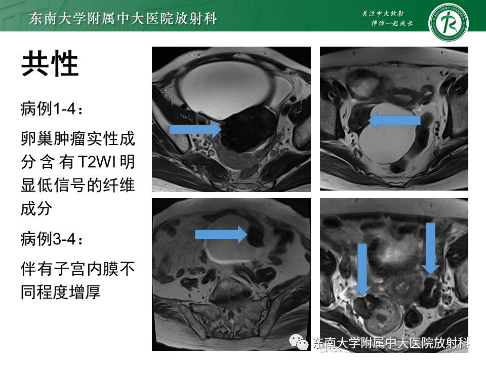 影像PPT - 【PPT】卵巢含纤维成份占位性病变分析-17
