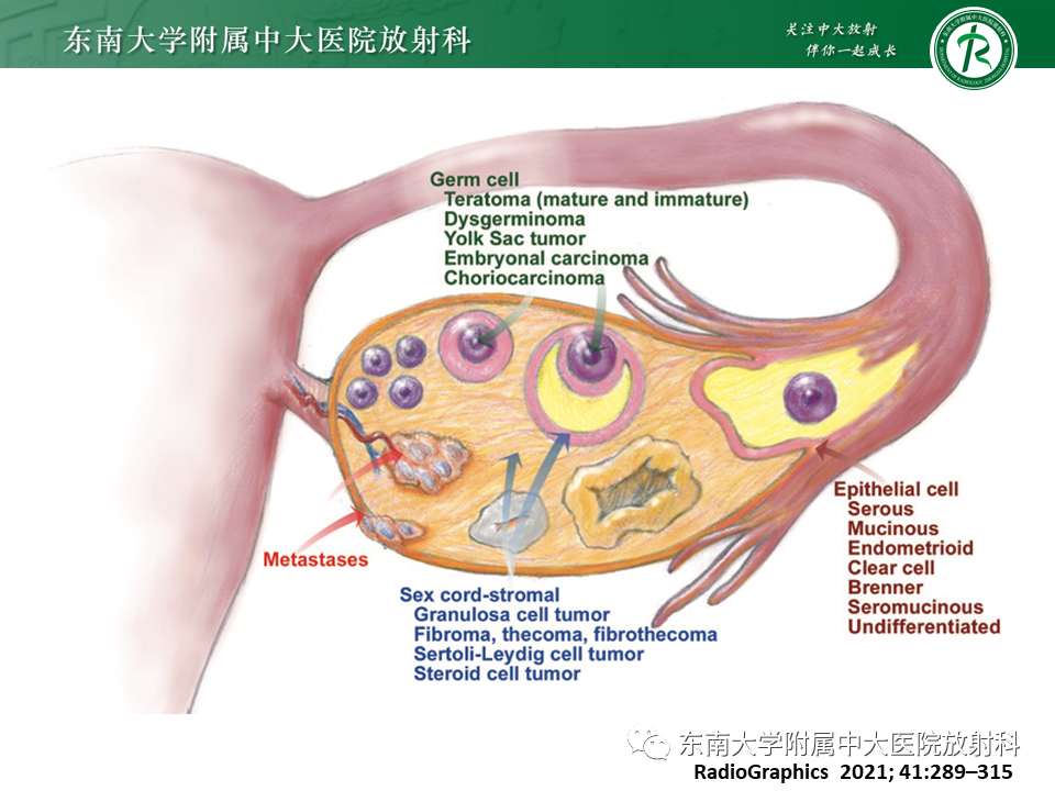影像PPT - 【PPT】卵巢含纤维成份占位性病变分析-20