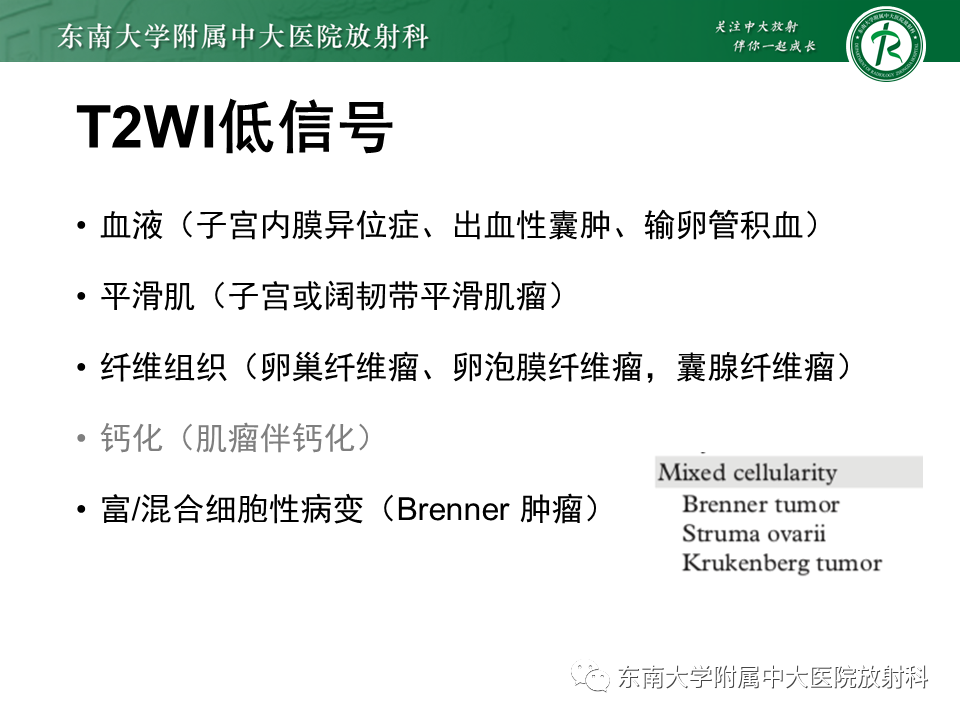 影像PPT - 【PPT】卵巢含纤维成份占位性病变分析-21