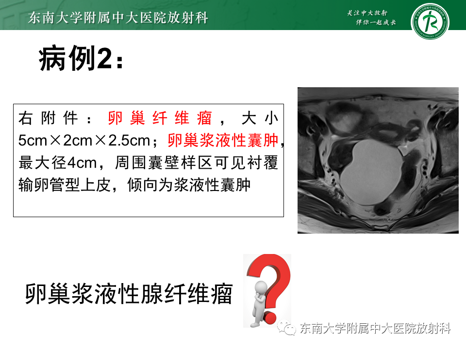 影像PPT - 【PPT】卵巢含纤维成份占位性病变分析-23