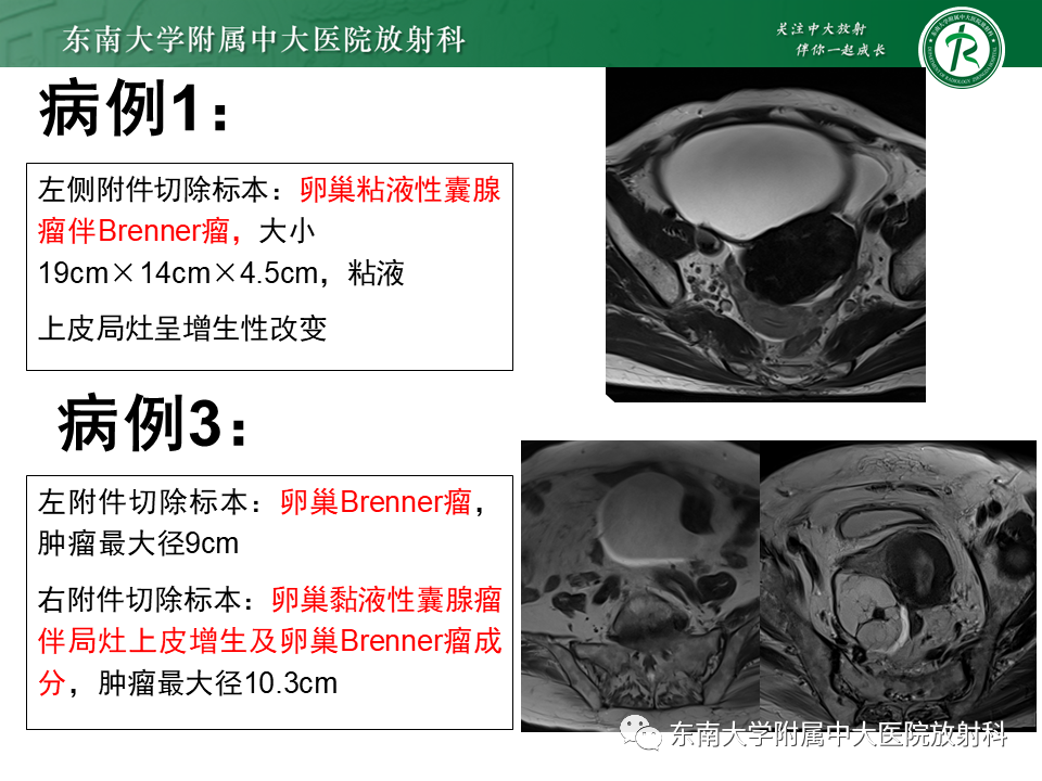 影像PPT - 【PPT】卵巢含纤维成份占位性病变分析-25