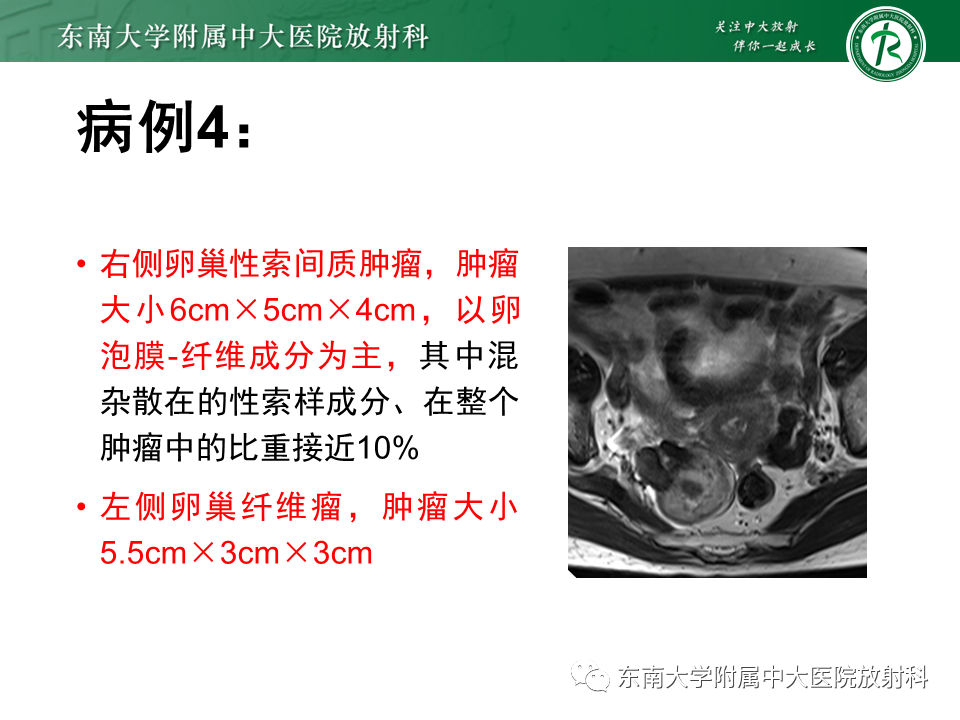 影像PPT - 【PPT】卵巢含纤维成份占位性病变分析-27