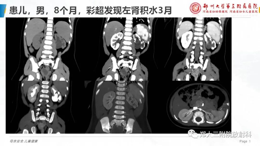 影像PPT - 【PPT】膀胱输尿管返流的影像诊断-1