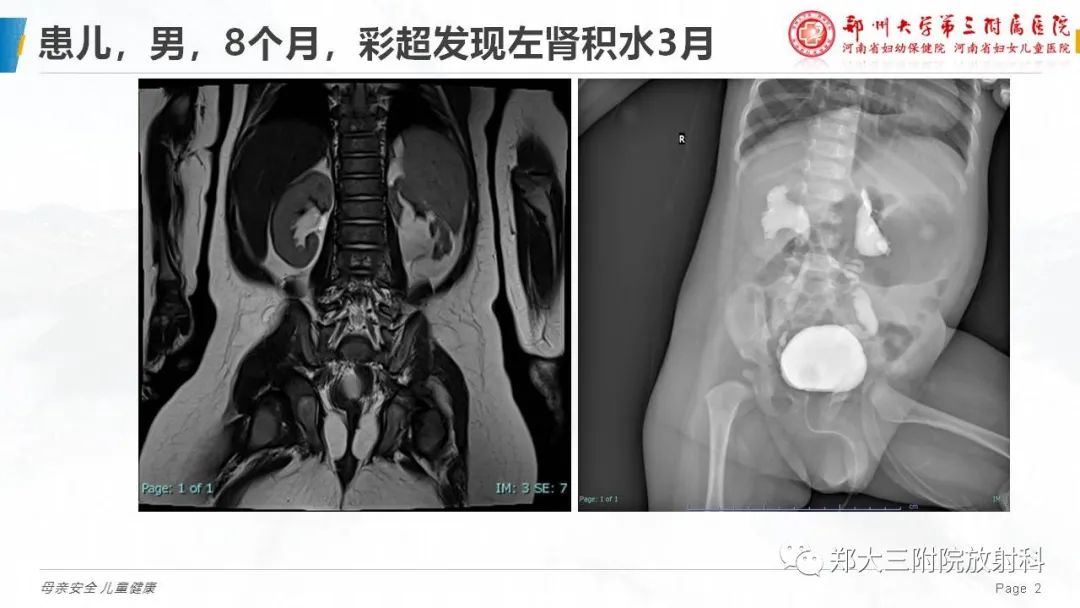 影像PPT - 【PPT】膀胱输尿管返流的影像诊断-2