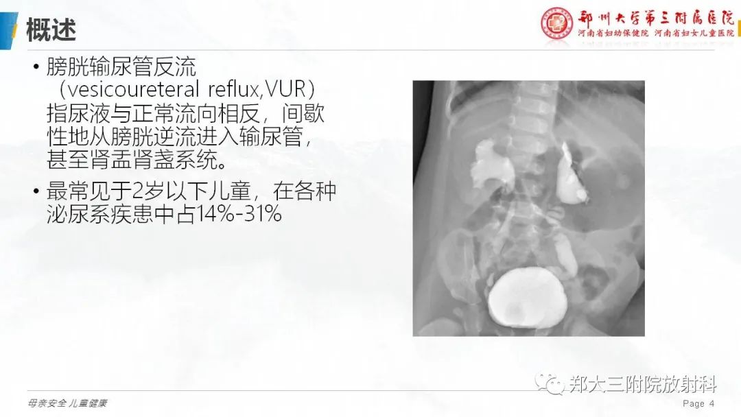 影像PPT - 【PPT】膀胱输尿管返流的影像诊断-4