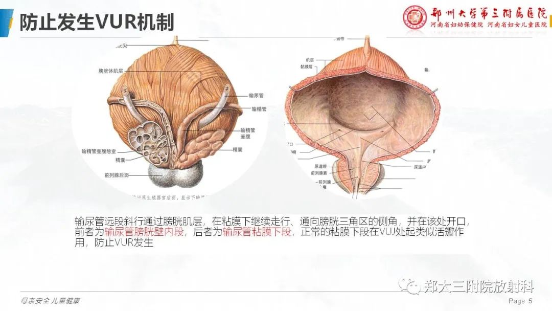 影像PPT - 【PPT】膀胱输尿管返流的影像诊断-5
