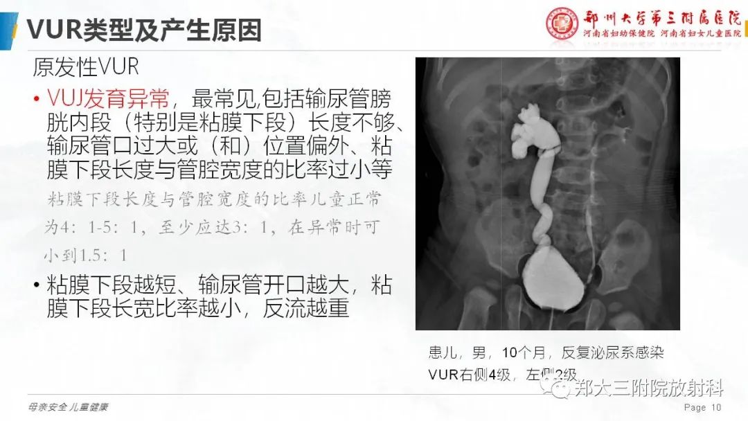 影像PPT - 【PPT】膀胱输尿管返流的影像诊断-10