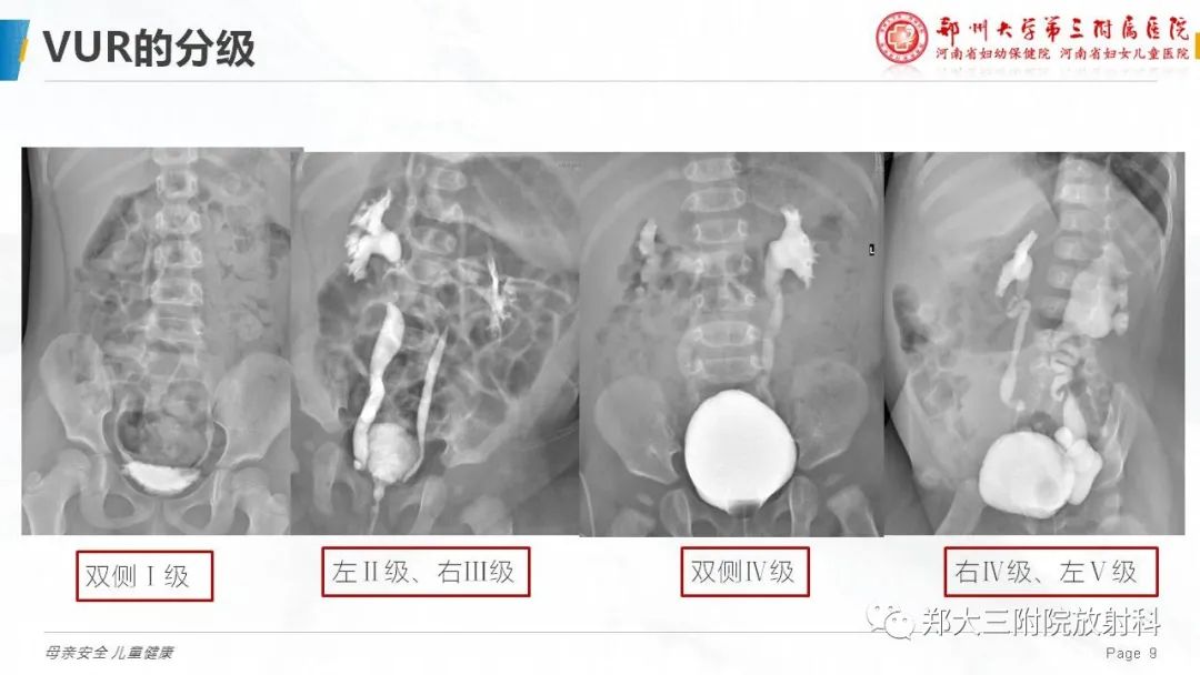 影像PPT - 【PPT】膀胱输尿管返流的影像诊断-9