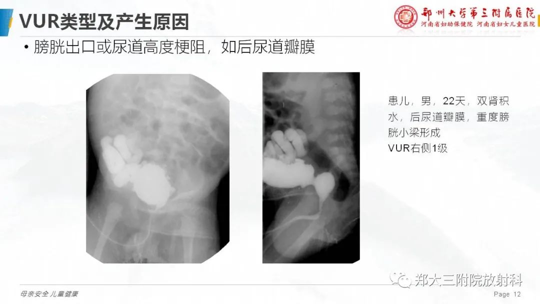影像PPT - 【PPT】膀胱输尿管返流的影像诊断-12