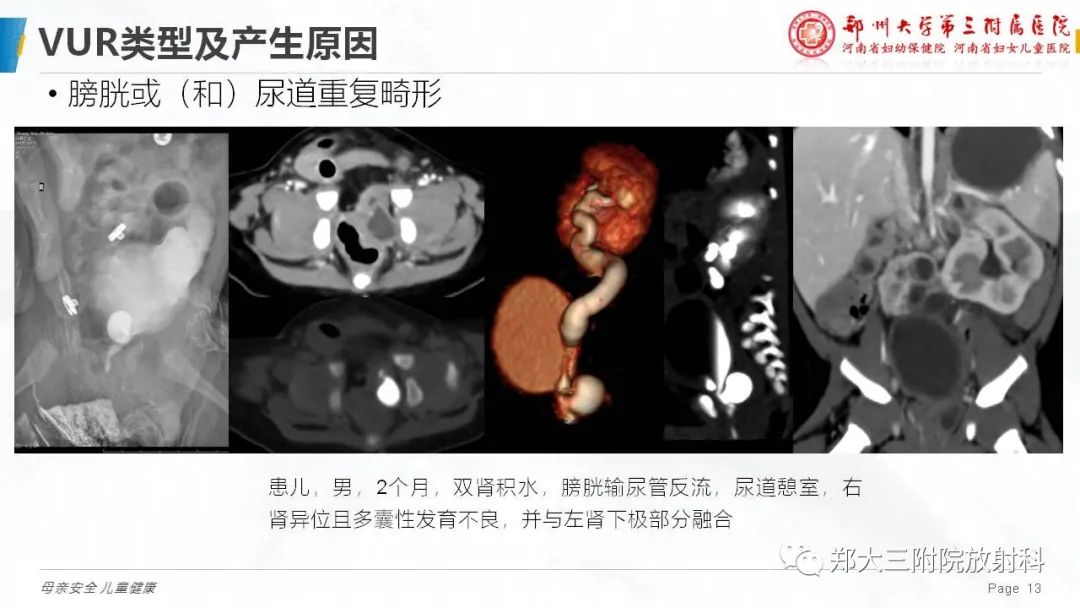 影像PPT - 【PPT】膀胱输尿管返流的影像诊断-13