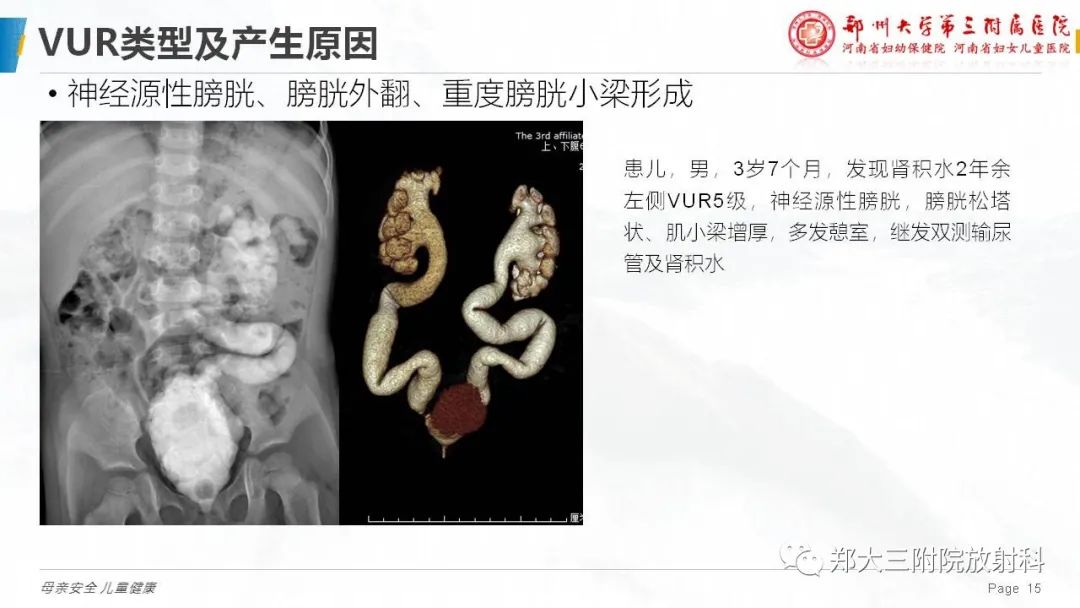 影像PPT - 【PPT】膀胱输尿管返流的影像诊断-15