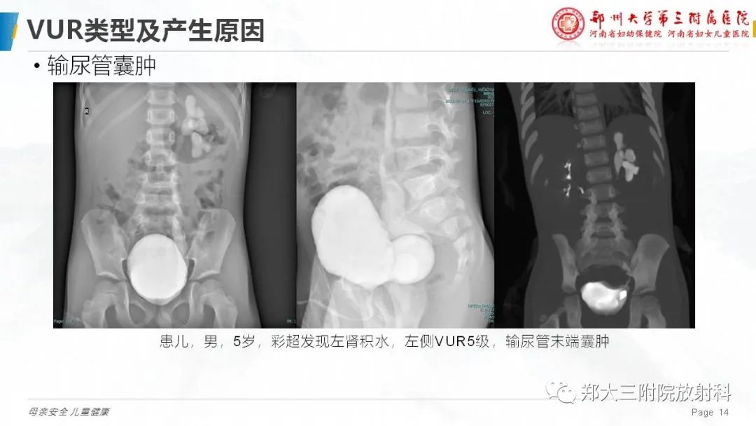 影像PPT - 【PPT】膀胱输尿管返流的影像诊断-14
