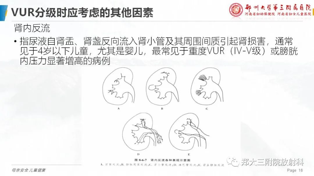 影像PPT - 【PPT】膀胱输尿管返流的影像诊断-16