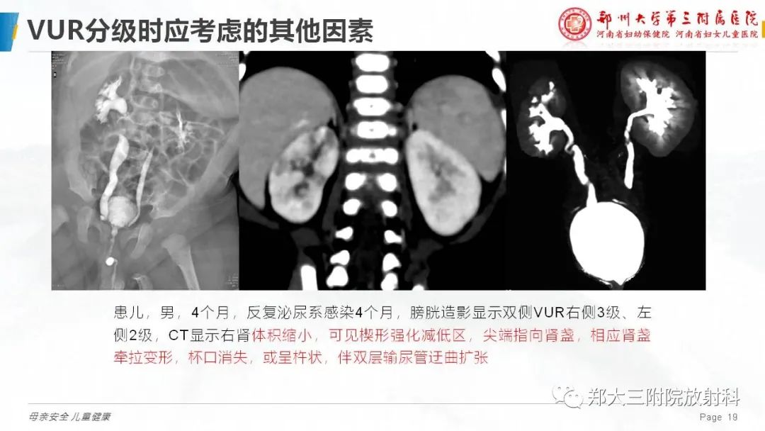 影像PPT - 【PPT】膀胱输尿管返流的影像诊断-19