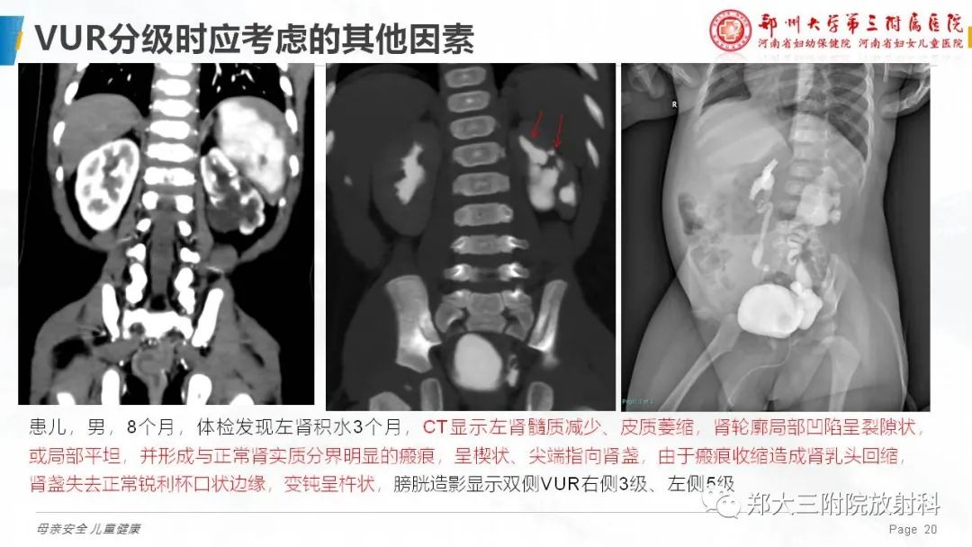 影像PPT - 【PPT】膀胱输尿管返流的影像诊断-20