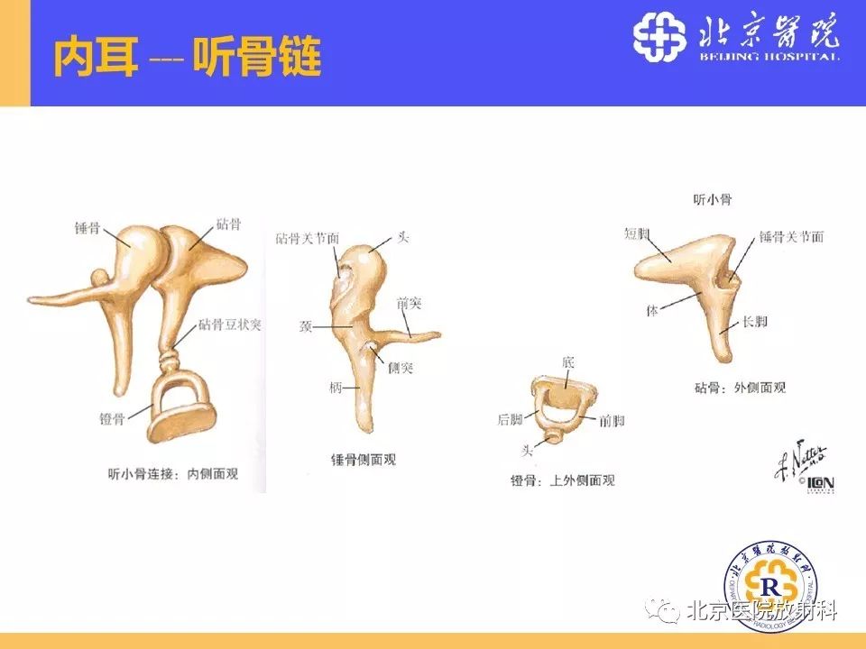 影像PPT - 【PPT】常见内耳畸形及后天获得性病变的影像表现-6
