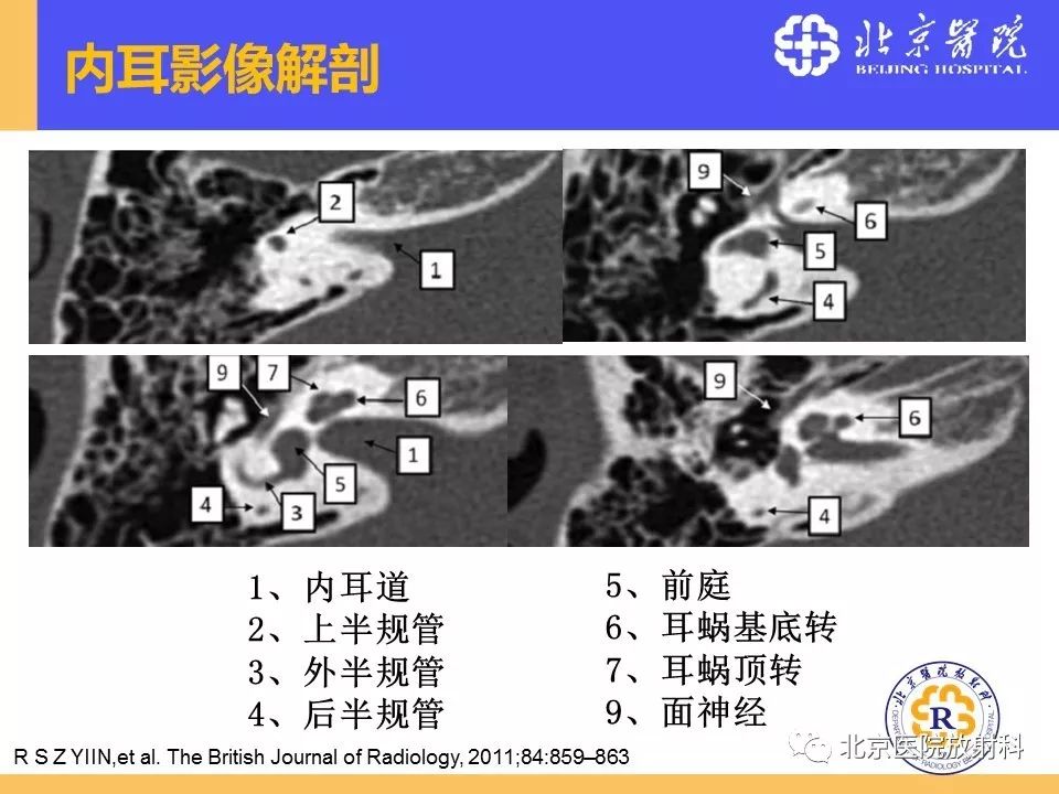 影像PPT - 【PPT】常见内耳畸形及后天获得性病变的影像表现-9