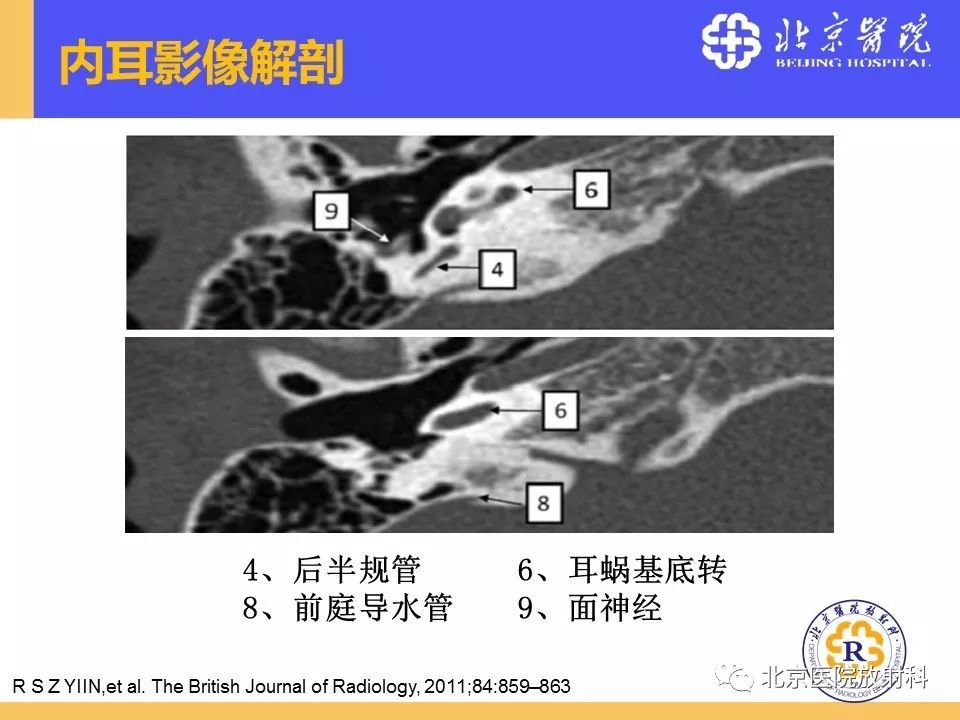 影像PPT - 【PPT】常见内耳畸形及后天获得性病变的影像表现-10