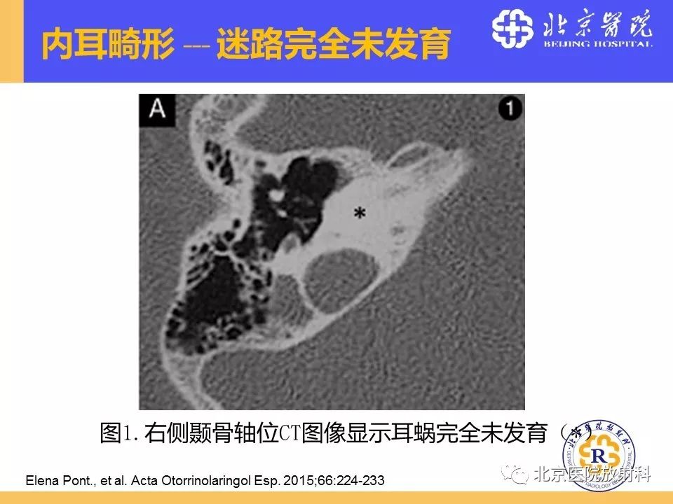 影像PPT - 【PPT】常见内耳畸形及后天获得性病变的影像表现-13