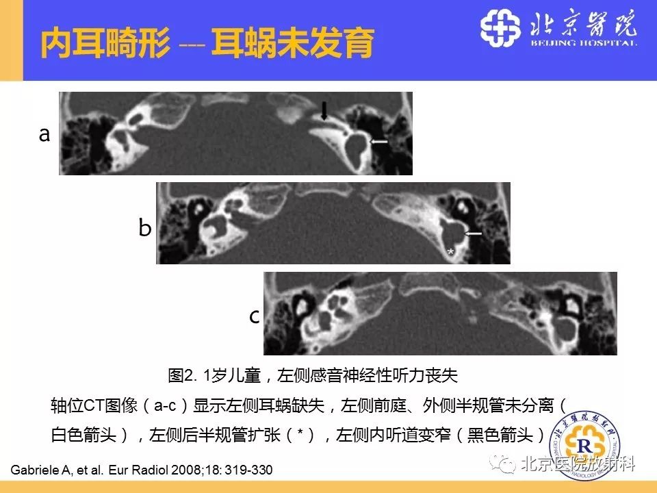 影像PPT - 【PPT】常见内耳畸形及后天获得性病变的影像表现-15
