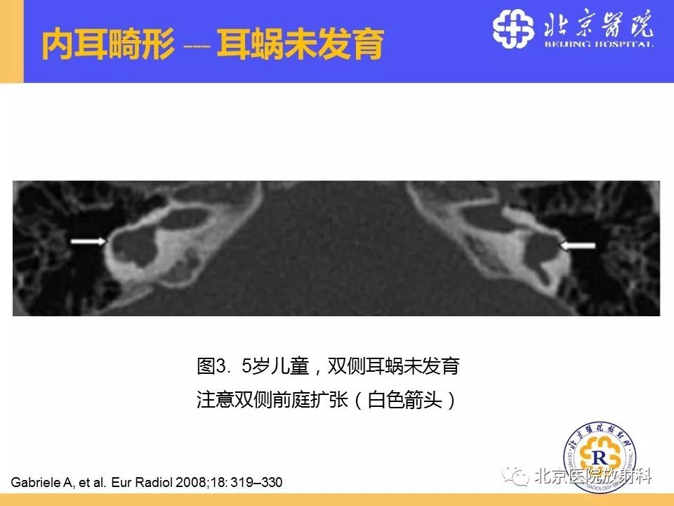 影像PPT - 【PPT】常见内耳畸形及后天获得性病变的影像表现-16