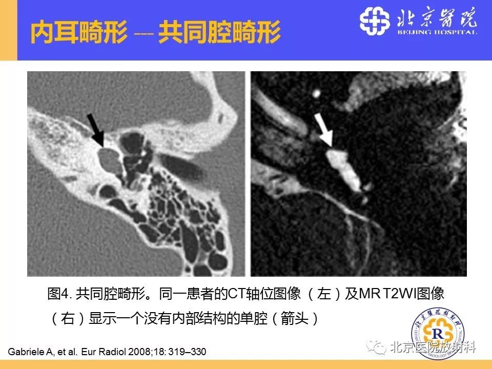 影像PPT - 【PPT】常见内耳畸形及后天获得性病变的影像表现-18