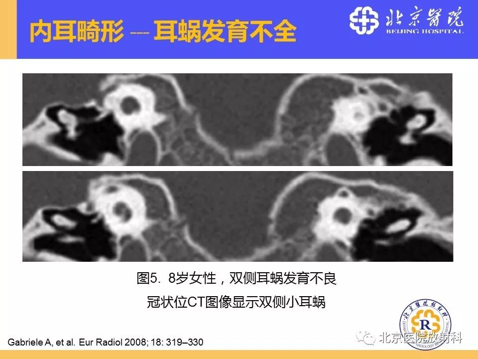 影像PPT - 【PPT】常见内耳畸形及后天获得性病变的影像表现-19