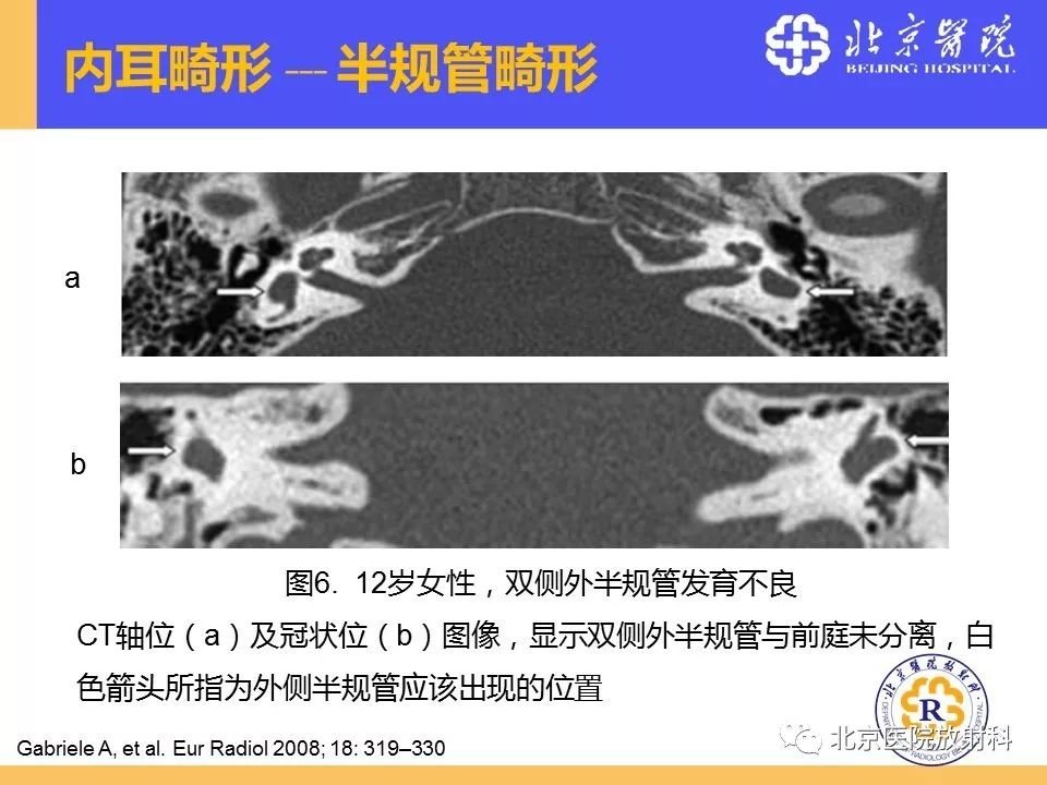 影像PPT - 【PPT】常见内耳畸形及后天获得性病变的影像表现-21