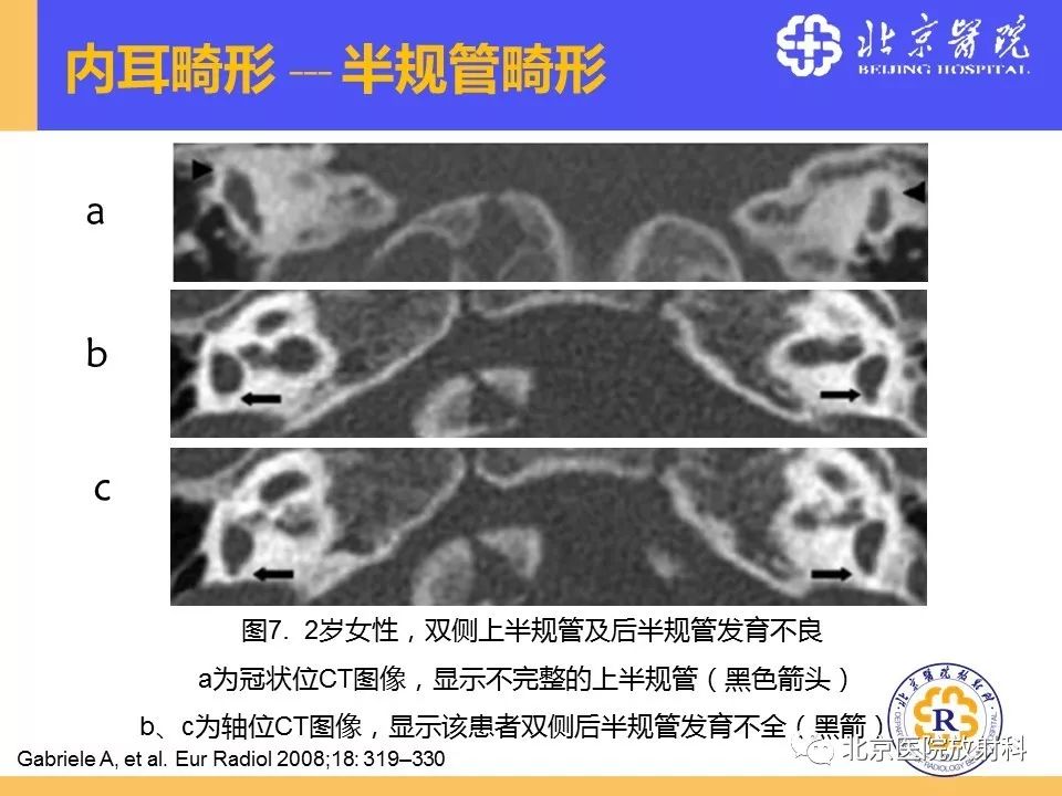 影像PPT - 【PPT】常见内耳畸形及后天获得性病变的影像表现-22